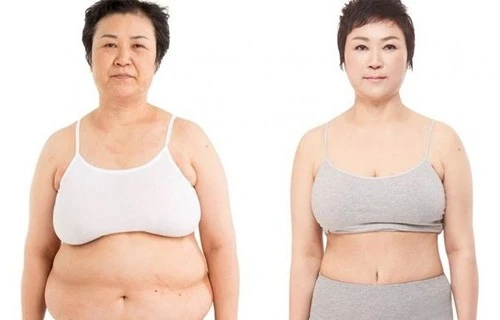 3-d-liposakciya-jk 3-d-liposakciya-jk