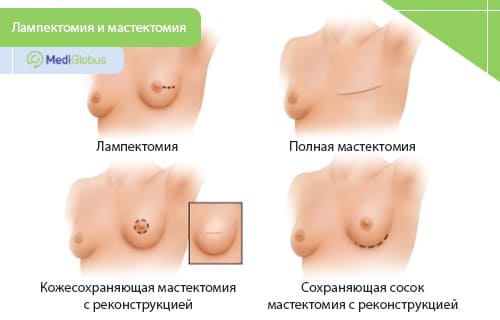 Современная хирургия рака груди