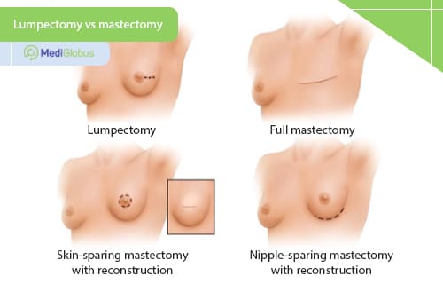 types of M\modern breast cancer surgery abroad