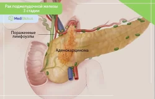 3 стадия рака поджелудочной железы схематическое изображение поджелудочной железы и опухоли 3-й стадии