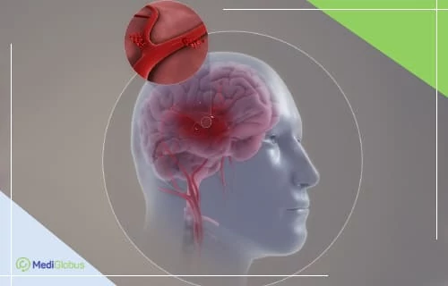 Нарушение кровотока и образование тромба в сосудах мозга 3D-иллюстрация мозга с кровеносными сосудами и тромбом в артерии