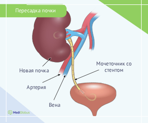 kidneytransplant_surgery_rus Схема пересадки почки
