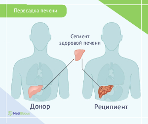 livertransplant_surgery_rus Схема пересадки печени