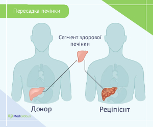 livertransplant_surgery_ukr Схема операції по пересадці печінки