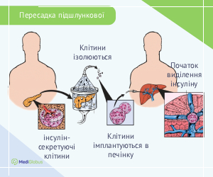 pancreastransplant_surgery_ukr Схема операції по пересадці підшлункової залози
