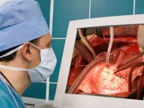 Aortocoronary Bypass CABG