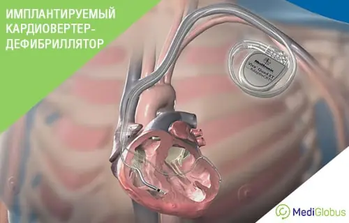 Кардиолог отвечает на часто задаваемые вопросы о кардиостимуляторах