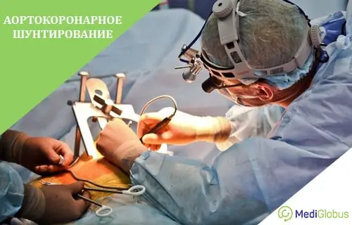 Аортокоронарное шунтирование хирург выполняет операцию на открытом сердце в операционной