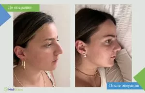 ринопластика в турции до после