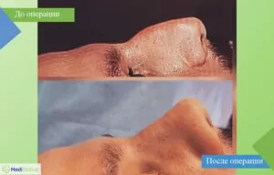 ринопластика в турции до после