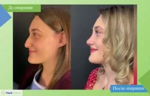 ринопластика в турции до после