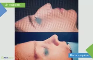 ринопластика в турции до после