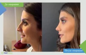 rhinoplasty in turkey before after photo