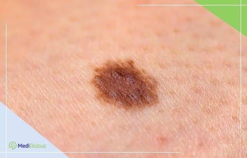 лечение меланомы кожи