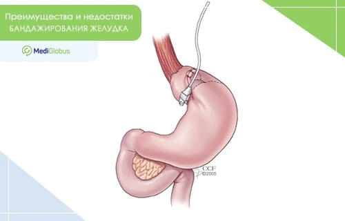 Преимущества и недостатки бандажирования желудка Изображение желудка после бандажирования