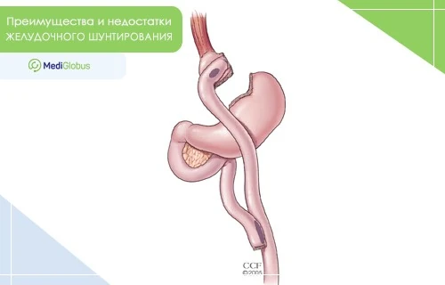 Преимущества и недостатки шунтирования желудка