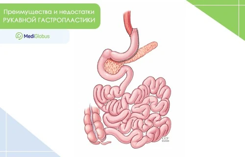 Преимущества и недостатки рукавной гастропластики Иллюстрация, изображающая органы ЖКТ после рукавной гастропластики