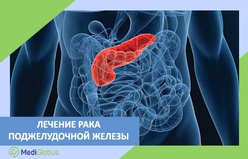 Рак поджелудочной железы — причины, симптомы, шансы на излечение