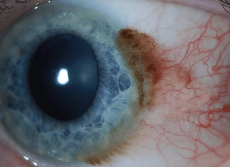 Melanoma Of The Eye Treatment