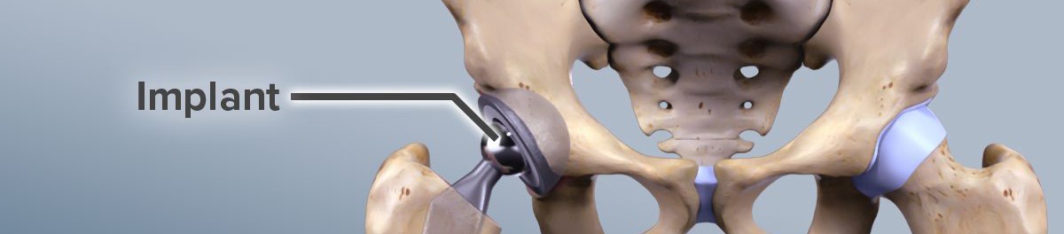 Knee and Hip Replacement Surgery