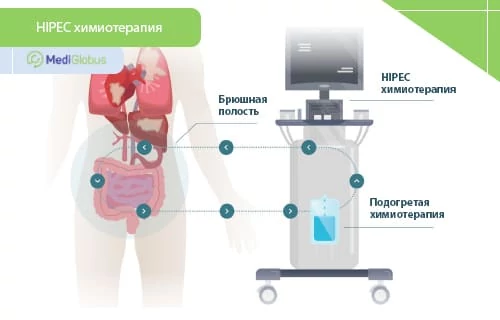 химиотерапия hipec при раке желудка схема проведения HIPEC‑терапии