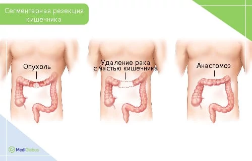 Резекция кишечника Схематические изображения этапов удаления опухоли кишечника