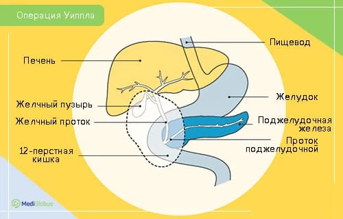 Операция Уиппла при раке кишечника Медицинская схема органов пищеварительной системы с обозначением участков, задействованных в операции Уиппла