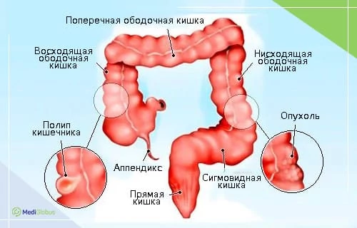 Что такое рак кишечника? Медицинская схема толстого кишечника человека с подписями отделов и патологиями