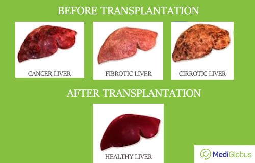 Comparing healthy liver to cancer, cirrotic and fibrotic liver