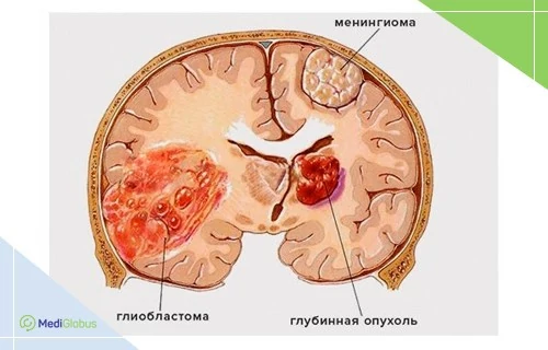 Медицинская иллюстрация поперечного среза головного мозга, на которой показаны три типа опухолей: менингиома в оболочках мозга, глиобластома в лобной доле и глубинная опухоль в центральных структурах; анатомические области выделены цветом и подписями.