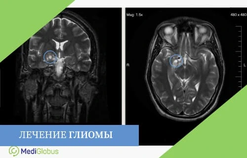 лечение глиомы за рубежом