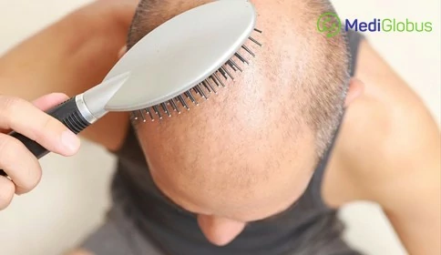 Answers to FAQs about Hair Transplant