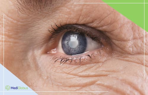 cataract