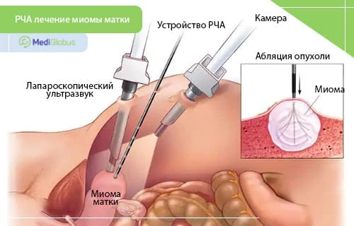 Радиочастотная абляция - безопасный метод лечения миомы матки Схематическое изображение проведения процедуры радиочастотной абляции
