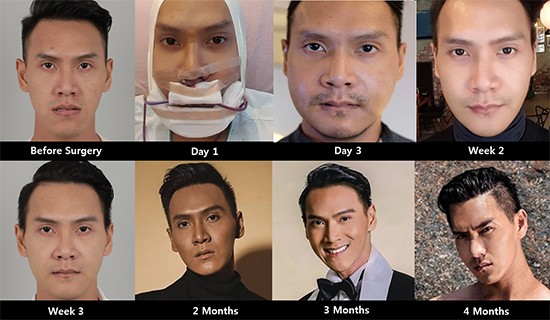6 month after plastic surgery at id hospital