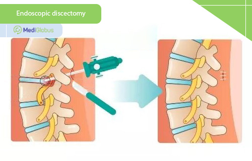 endoscopic discectomy