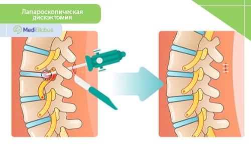 Лапароскопическая дискэктомия проводится с помощью специального микроскопа и микроинструментов и не требует больших разрезов Медицинская иллюстрация лапароскопической дискэктомии: на схеме показано удаление части межпозвоночного диска через небольшой разрез с использованием эндоскопа и инструмента; справа — результат операции с зашитым разрезом.
