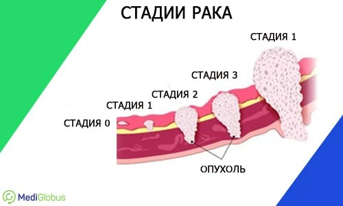 стадии рака и воздействие на ткани схематическое изображение различных стадий рака и его воздействия на ткани