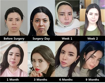 6 month after plastic surgery at id hospital