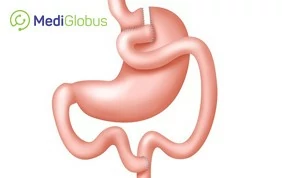bariatric surgery abroad