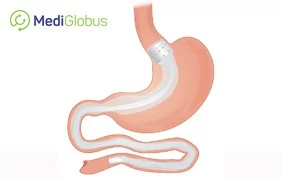 treatment of obesity abroad
