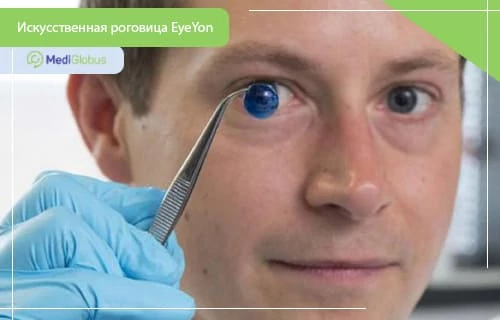 искусственная роговица EyeYon