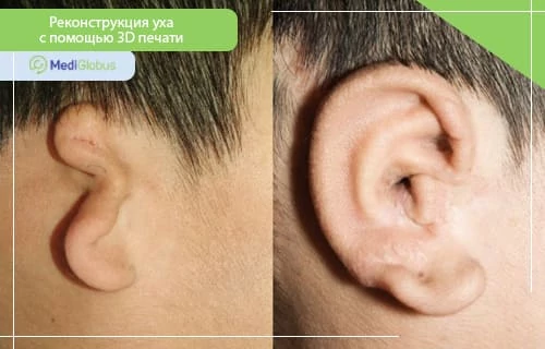 3d печать уха