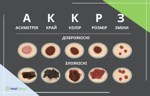 Чим звичайна родимка відрізняється від меланоми Інфографіка: Як відрізнити родимку від меланоми