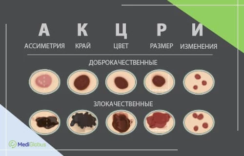 чем обычная родинка отличается от меланомы Инфографика: Как отличить родинку от меланомы