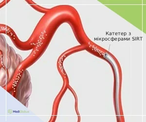 SIRT-catheter_ukr Катетер з мікросферами SIRT