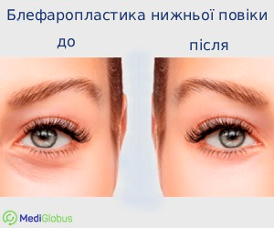blepharoplasty_beforeafter_ukr Фото до та після блефаропластики в Кореї