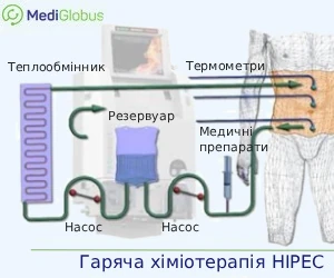 hipec_ukr Як проводиться гаряча хіміотерапія за методом HIPEC