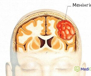 meningioma_ukr Менінгіома мозку