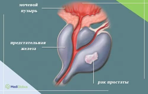 стоимость лечения рака простаты